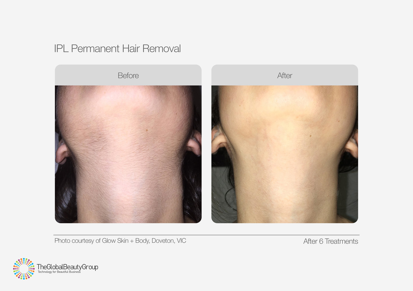 IPL Hair Reduction