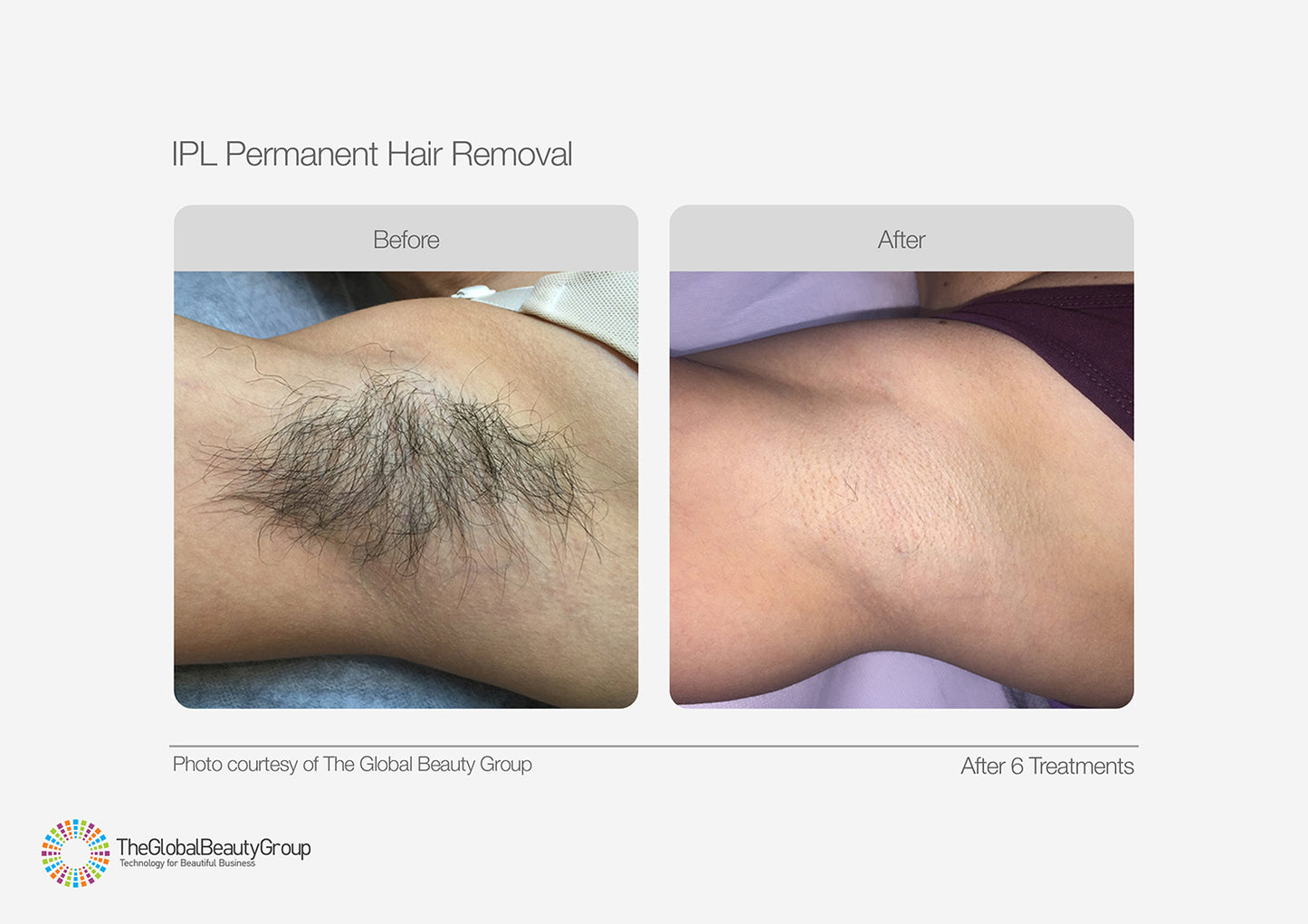 IPL Hair Reduction