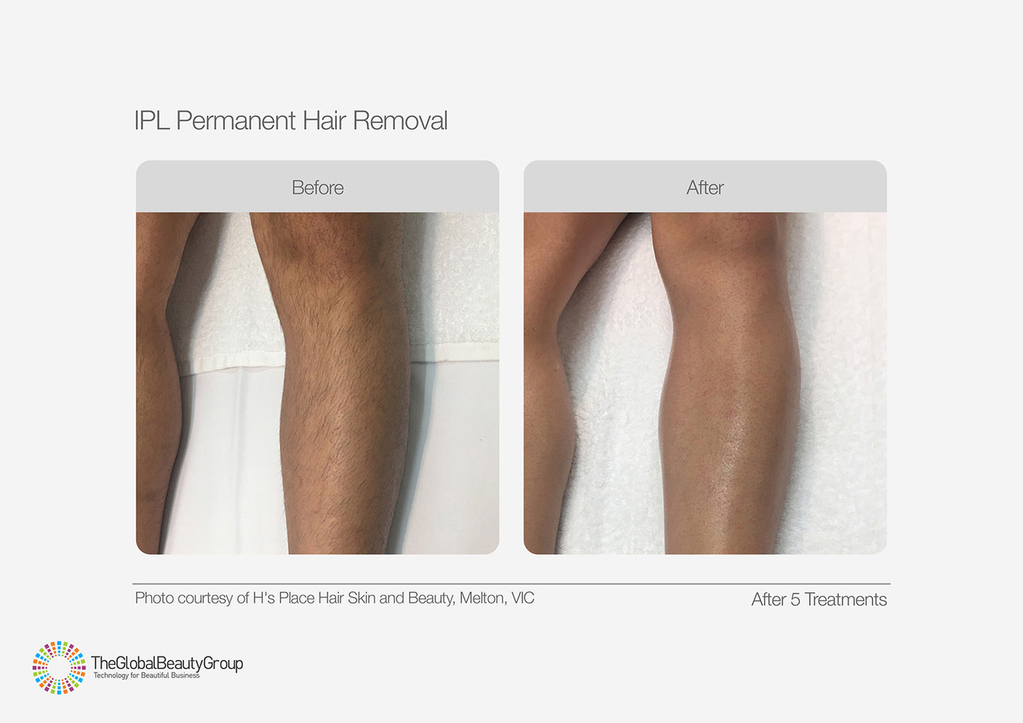IPL Hair Reduction